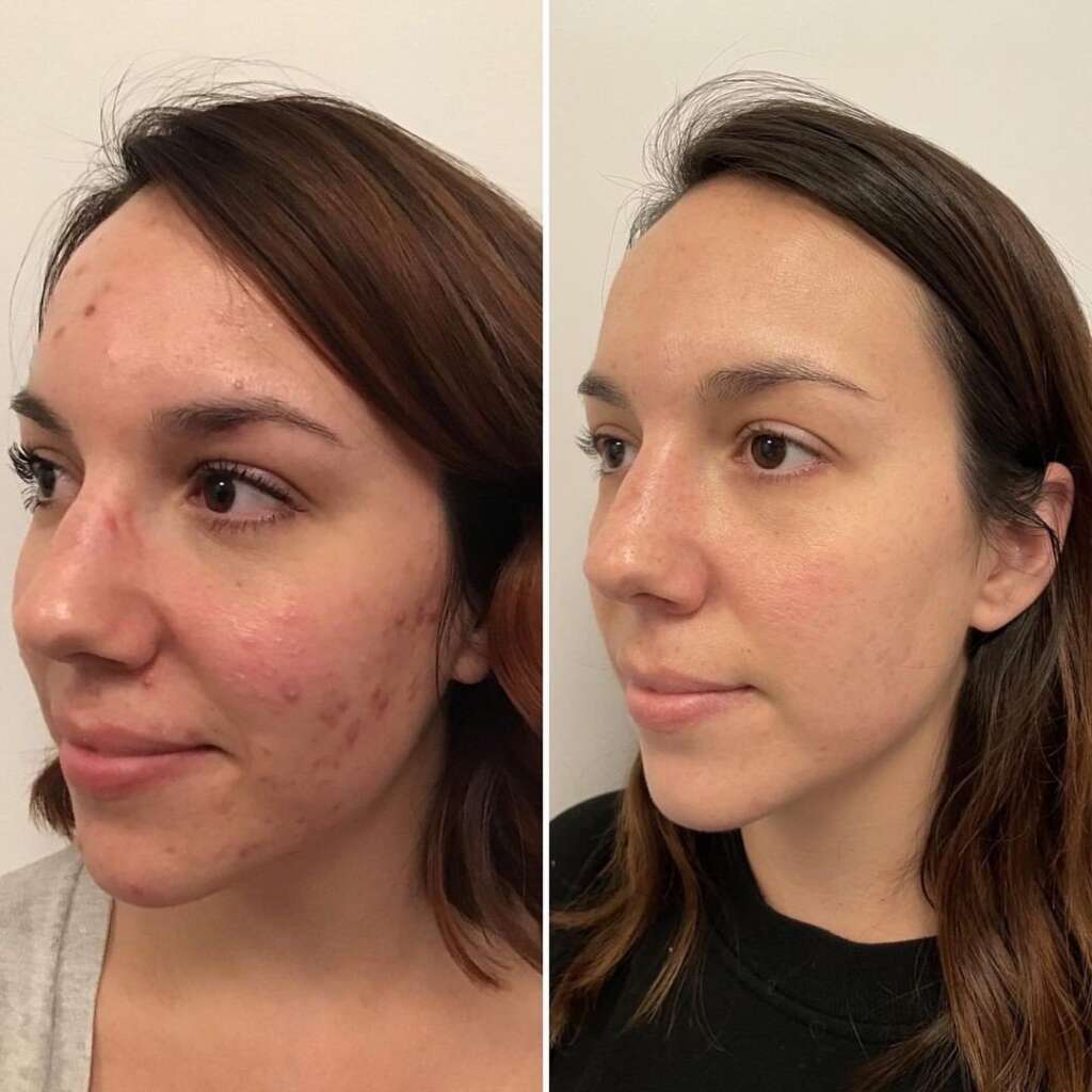 Aquafacial-Carbon-Peel-Before-After-2.jpg