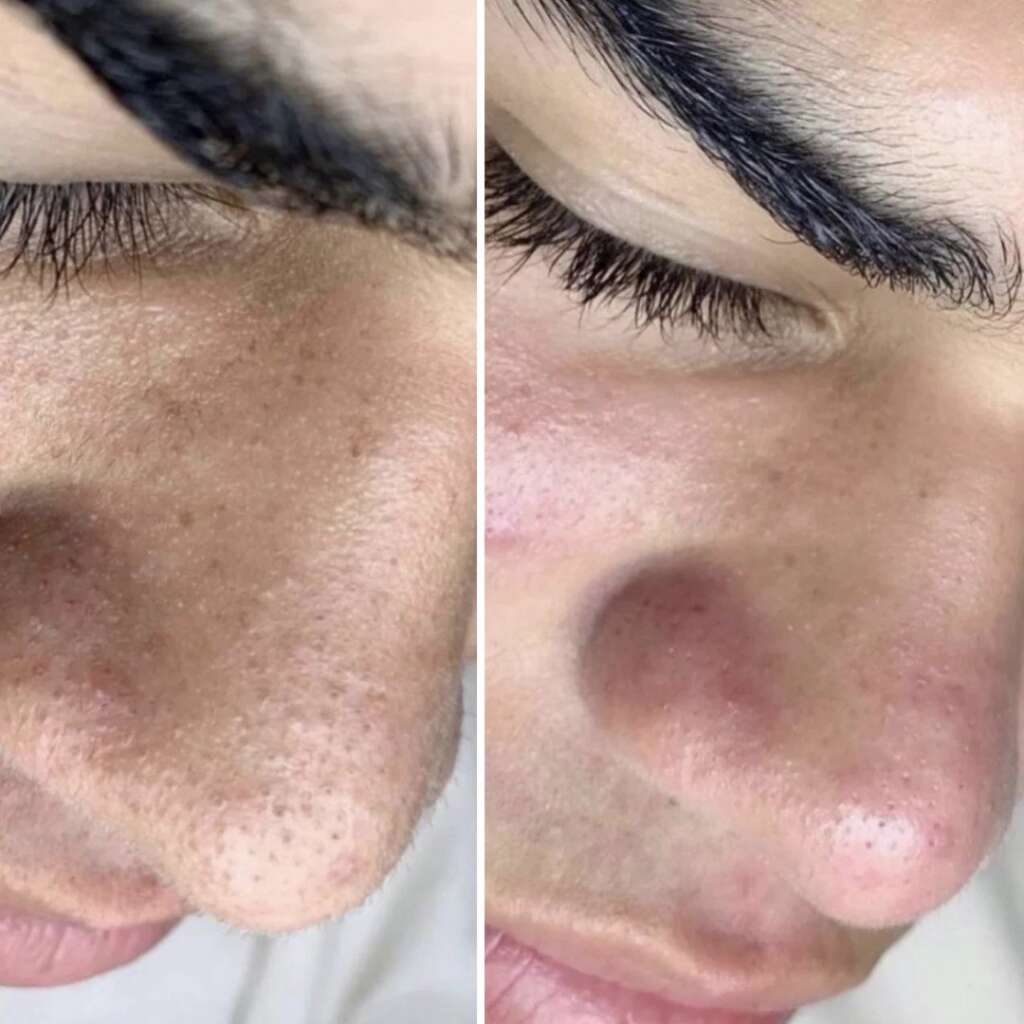 Aquafacial-Carbon-Peel-Before-After-3.jpg