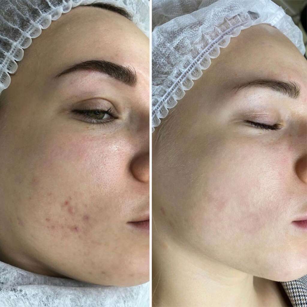 Aquafacial-Carbon-Peel-Before-After-4.jpg