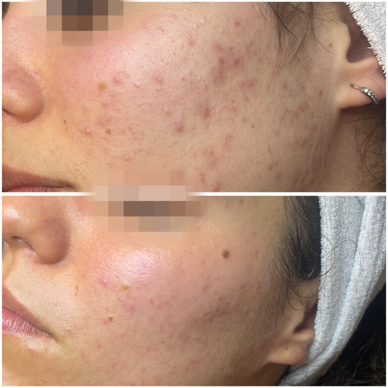 Balance problemas bor kezeles (1)