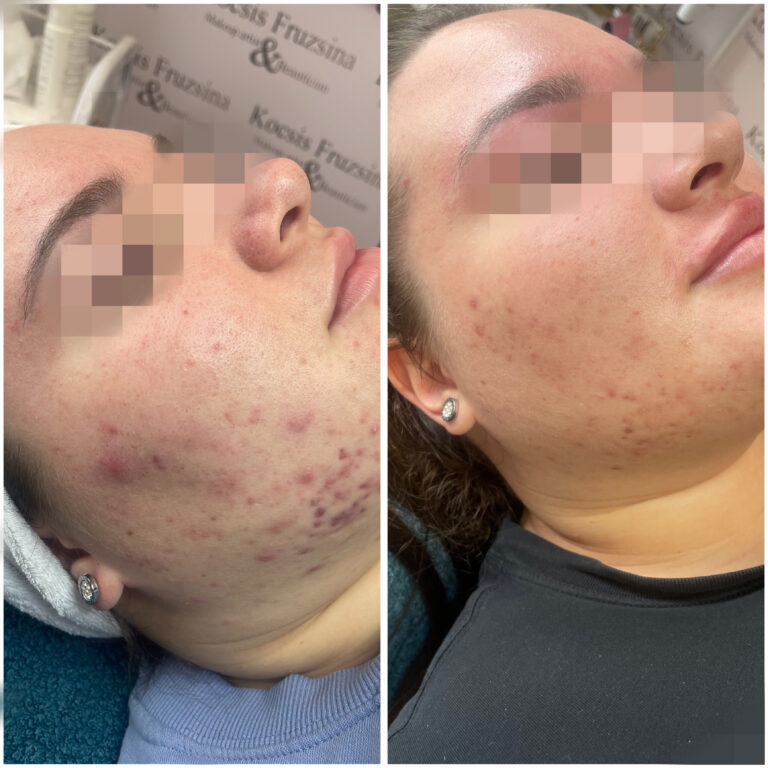 Balance problemas bor kezeles (2)