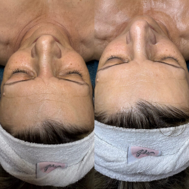 Delay Infinity Botox Like (3)