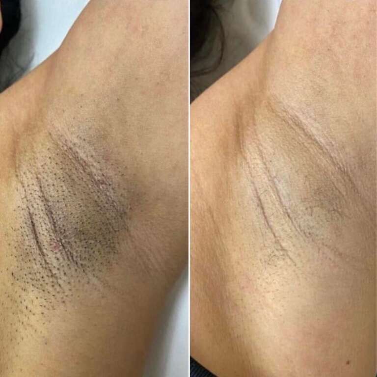 vegleges-szortelenites-1024x1024